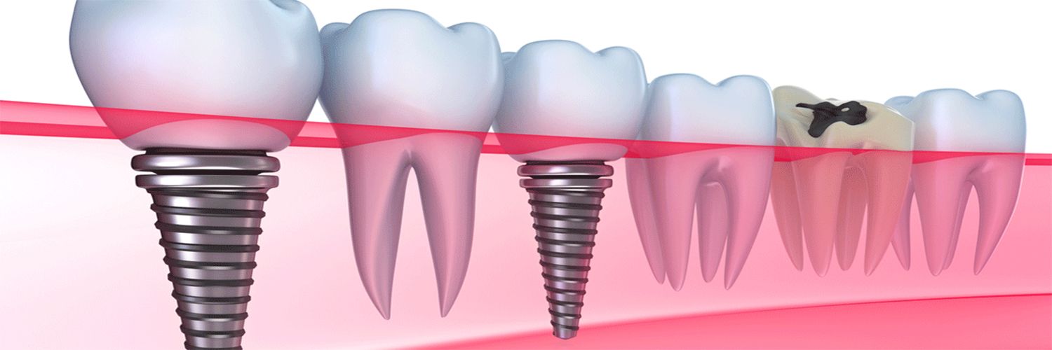 dental implants