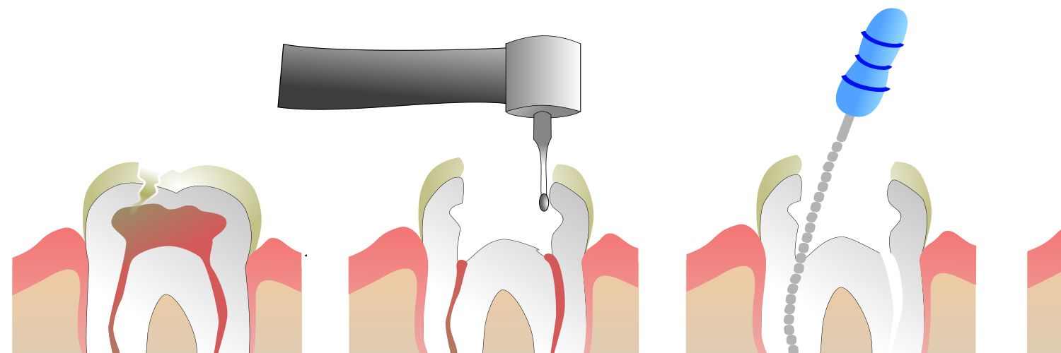 root canal treatment