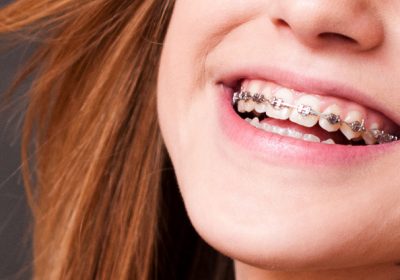 What are Orthodontics and its Importance?