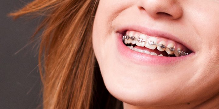 What are Orthodontics and its Importance?